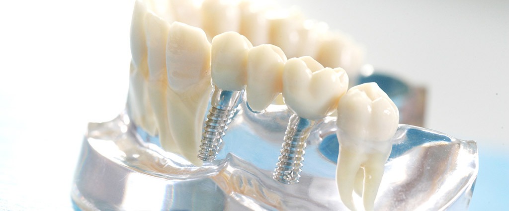 Implantologie, Zahnärzte Drs. König Bad-Dürkheim